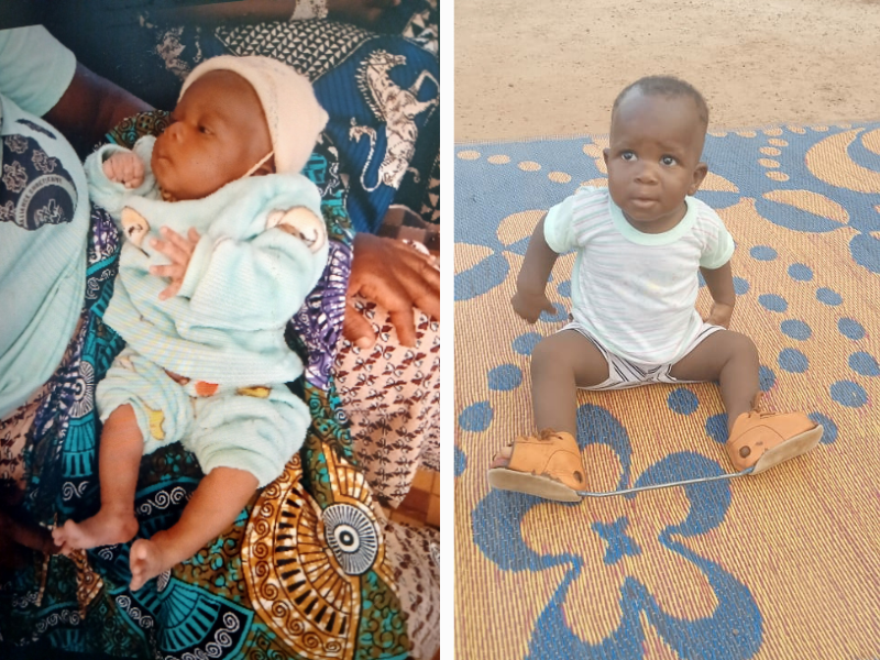 An infant is being held, and a child sits wearing a clubfoot support.